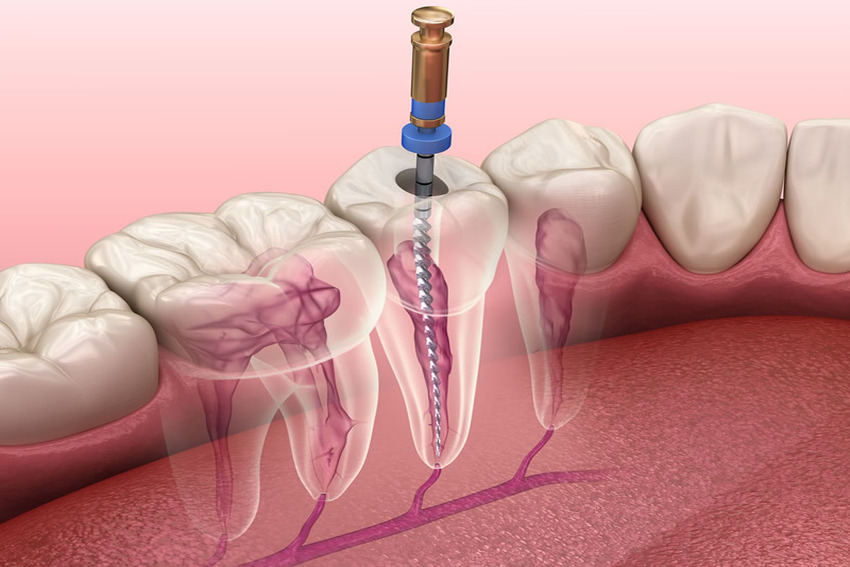 Endodontics (Root canal therapy)